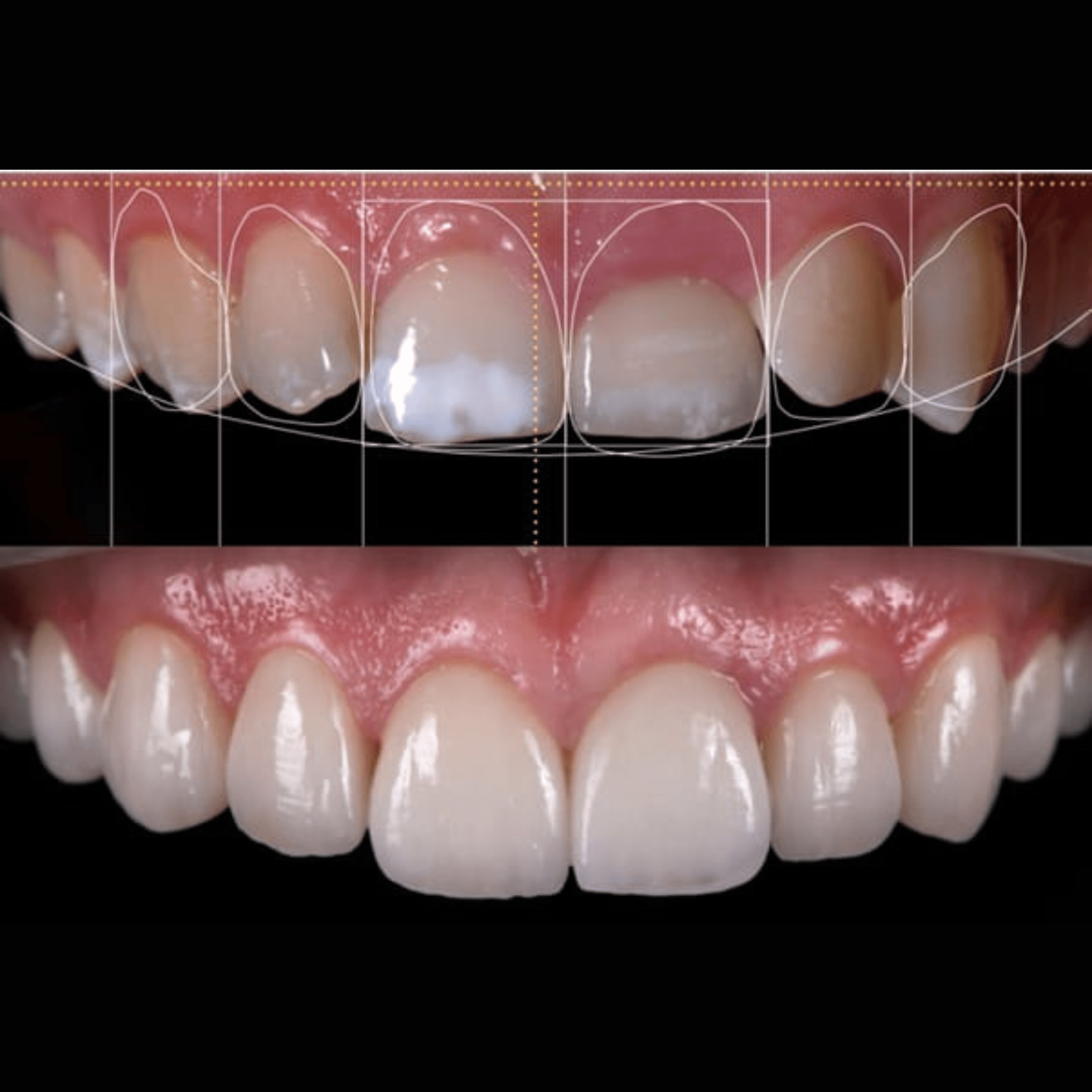 A digital preview and dental diagnostic setup showing custom cosmetic smile design planning for a patient