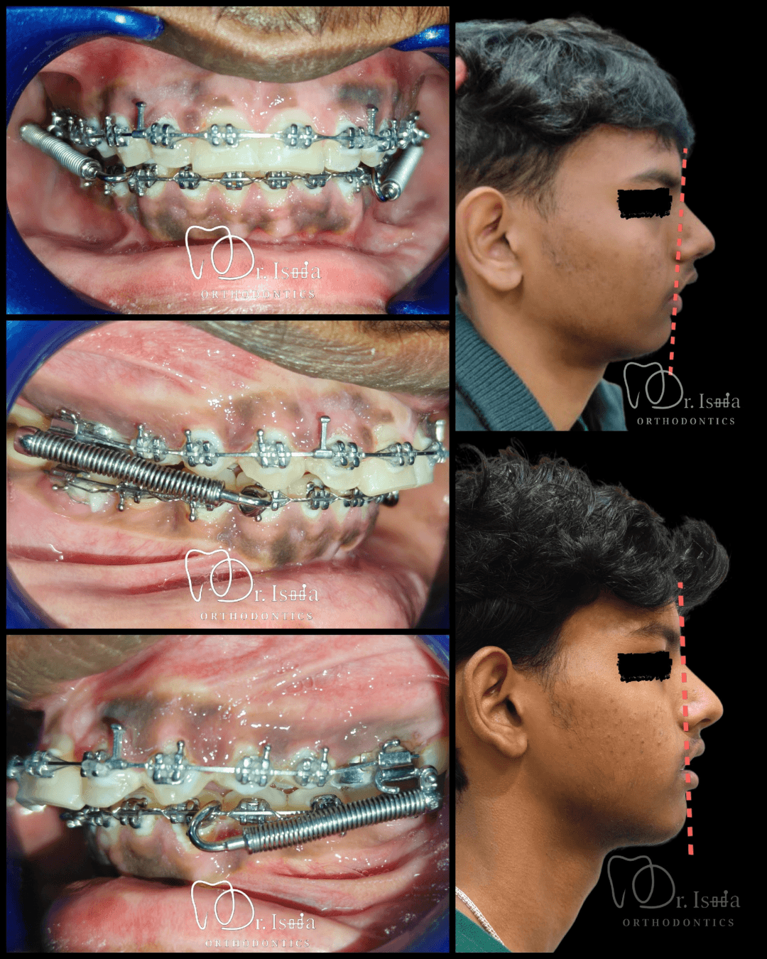 Smile transformation 3