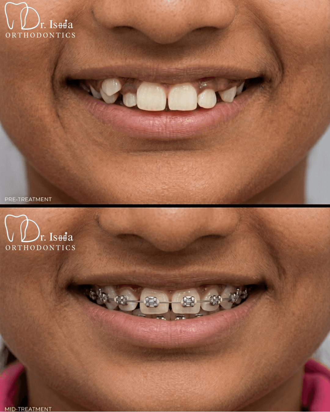 Aesthetic Gap Closure and Natural Tooth Restoration