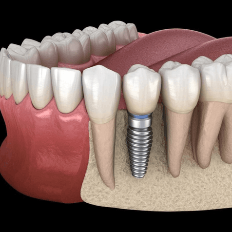 Dental Implants treatment