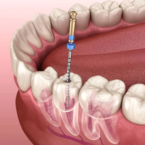 Root Canal treatment