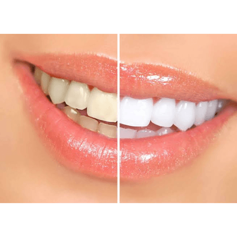 Teeth Whitening treatment